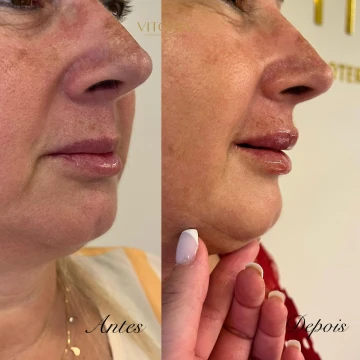 clinicavitoria_antesdepois12