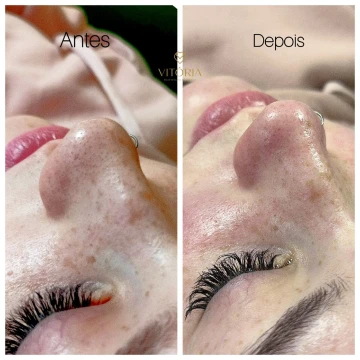 clinicavitoria_antesdepois4