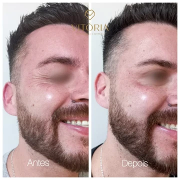 clinicavitoria_antesdepois6